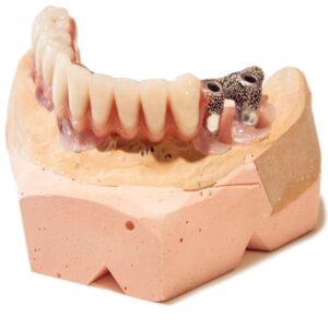 Barras Akerman e Híbridas