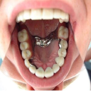 Prótesis esqueléticas